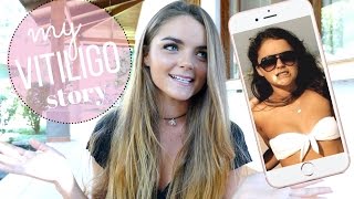Opening Up About My Vitiligo... | Tess Florio