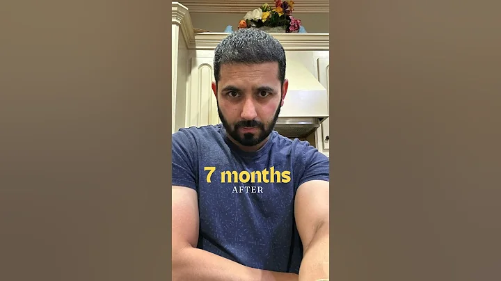 Hair transplant in India | Best cost of hair transplant #hairtransplantinindia #hairtransplant