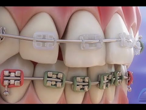 歯列矯正 - 要素とその役割 ©