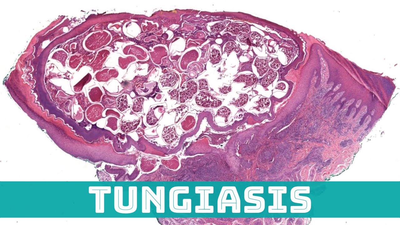 Tungiasis: a sand flea that burrows into your foot 