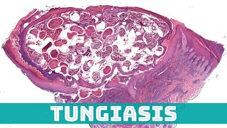 Tungiasis Sand Flea Under the Microscope (Tunga penetrans aka jigger flea skin pathology)