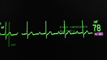 sinus rhythm, first degree AV block on an ECG heart monitor