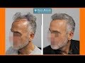 Fast Grower | Hair Transplant Results at 5.5 Months | Feller & Bloxham Medical, NY, NYC, Long Island