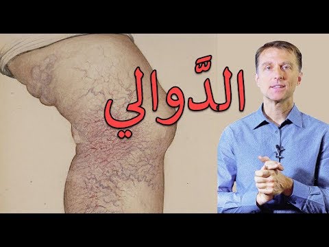 فيديو: نصائح غذائية خاصة بالدوالي