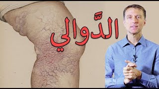 سبب الدوالي و الدوالي السطحية و علاجها | دكتور بيرج