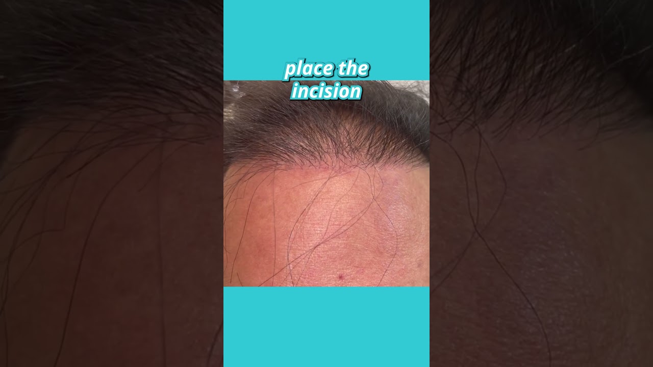 Osteoma Removal: Preserving the hairline and hiding the scar