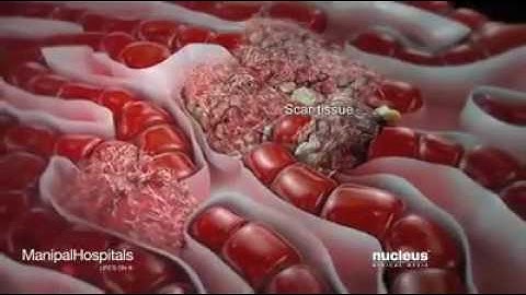 Hepatitis C 3D animation