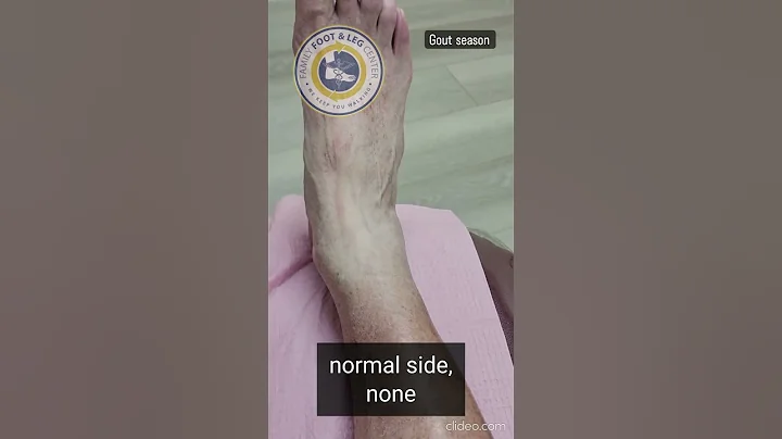 Gout Season - DayDayNews