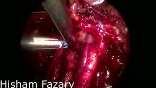 Endometrial carcinoma Total laparoscopic hysterectomy with BSO plus pelvic lymphadectomy