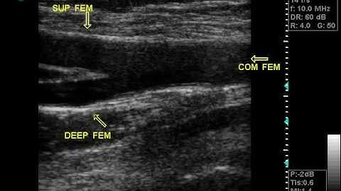DOPPLER VASCULAR ULTRASOUND OPTIMAL VIEW OF COMMON ARTERY