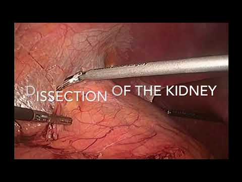 Laparoscopic Partial Nephrectomy 9p Renal Score