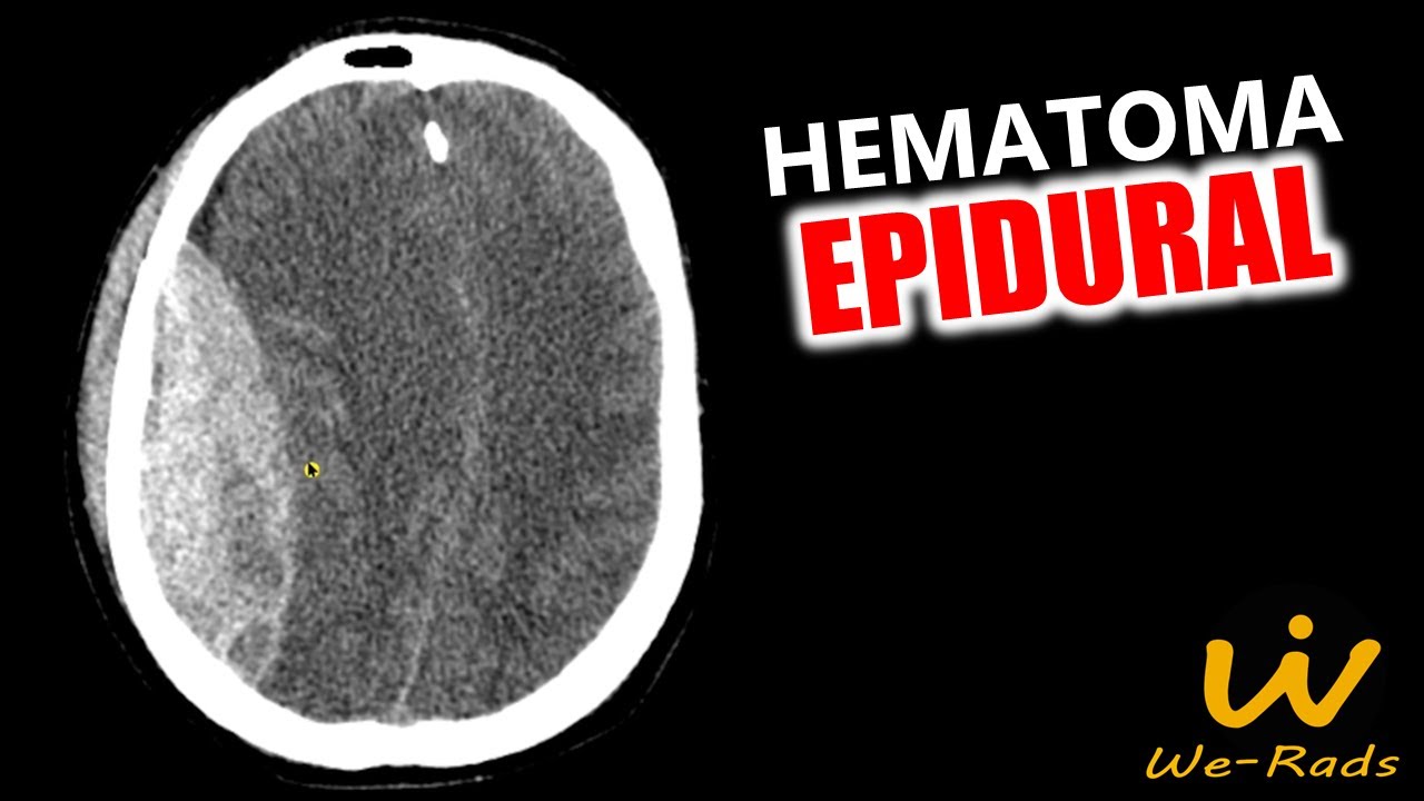 Hematoma Epidural YouTube