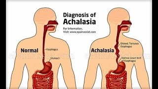 Discuss Esophaeal achalasia ; cardiac sphincter disorder ; Definition, Causes, Symptoms, Diagnosis