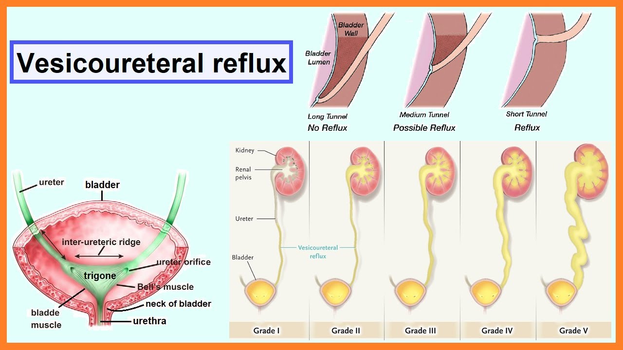 Vesicoureteral Reflux YouTube Vesicoureteral Reflux YouTube