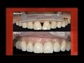 Unique Use of No Prep Veneers To Close Post Surgical Gingival Embrasures