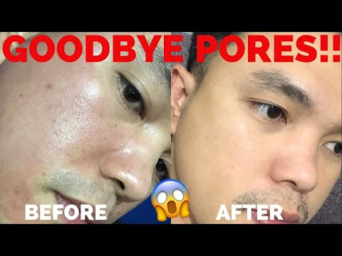 My Fractional CO2 Laser Experience (Philippines) : Lumiit ang pores ko -  YouTube