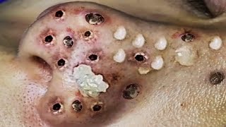 Treatment Satisfying blackhead relaxing  acne, pimple, cyst by FISHING VIDEO 96 views 1 year ago 5 minutes, 25 seconds