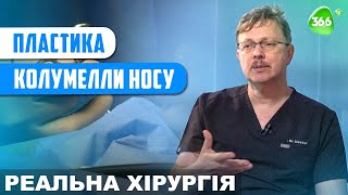 Пластика Колумелли Носу. Як Відновити Ніс за Допомогою Пластичної Хірургії?