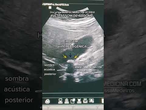 Vídeo: Os cálculos biliares apareceriam em um ultrassom?