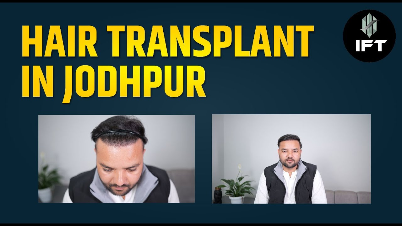 Hair Transplant In Jodhpur: The Truth About Results | IFT Hair Science