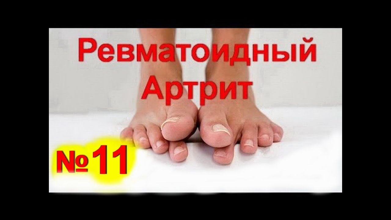 под чем снять воспаление суставов пальцев ног замечательная штука так