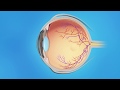 Macular Pucker: Cirugía de vitrectomía