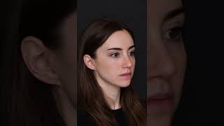 Obsessed with this glow! #rhinoplasty