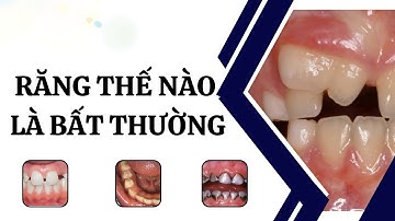 Răng thế nào là bất thường | Tt niềng răng quốc tế Diamond