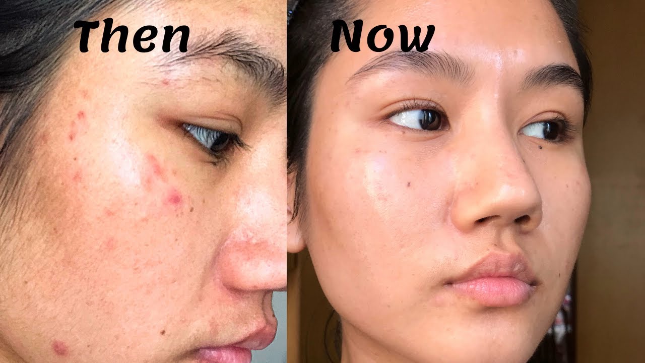 How To Treat Red Acne Marks Post Inflammatory Erythema Everything