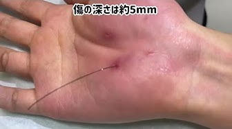 猫ひっかき病 Youtube