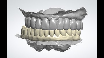 Design a Digital All on X Implants Bridge with the Thimble Crowns in 3Shape - Viet Dental Lab