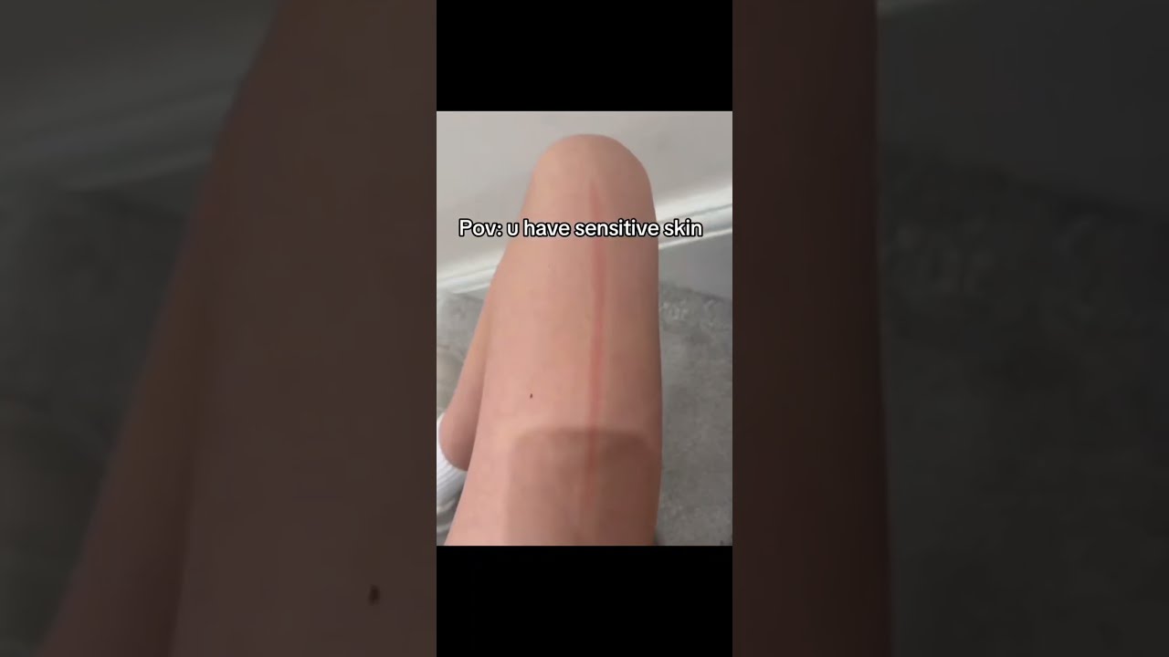 POV You Have Sensitive Skin