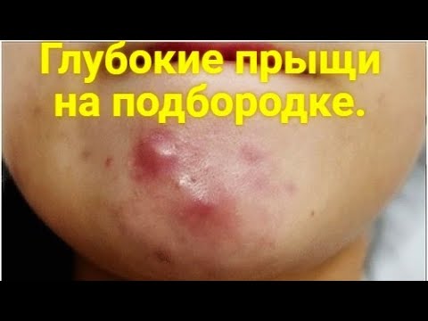 Глубокие прыщи на подбородке. Почему прыщи появляются и что с ними делать?