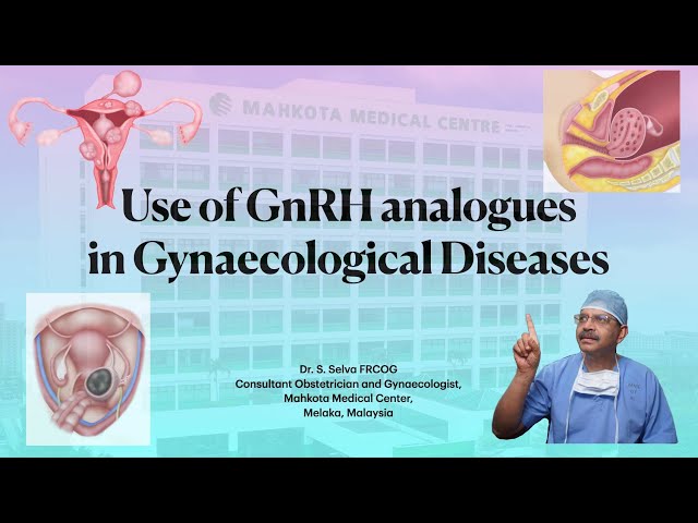 Role of GnRH analogue in Gynaecological Diseases - YouTube