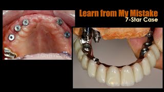 Learn from My Mistake: 7Star Case | Dental Lab Education