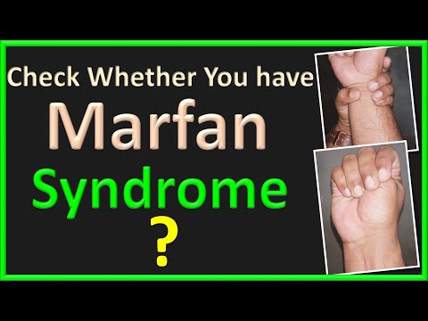 Video: Arachnodactyly: Tecken, Behandling, Foton, Orsaker