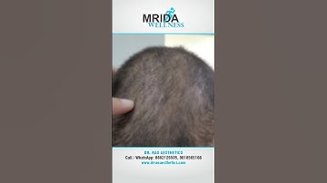 Scalp Micro Pigmentation (SMP): The Secret to a Fuller Head of Hair
