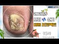 (Eng)무좀발톱 치료/케어 안 하고 10년 동안 방치한 케이스(ft. 스케일링) l Fungal/Ingrown toenails [NP케어]