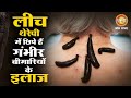 लीच थेरेपी में छिपे हैं गंभीर बीमारियों के इलाज | Leech Therapy Treatment | Jonk Chikitsa