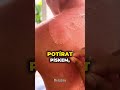 Co Dělat Když Se Spálíte?!