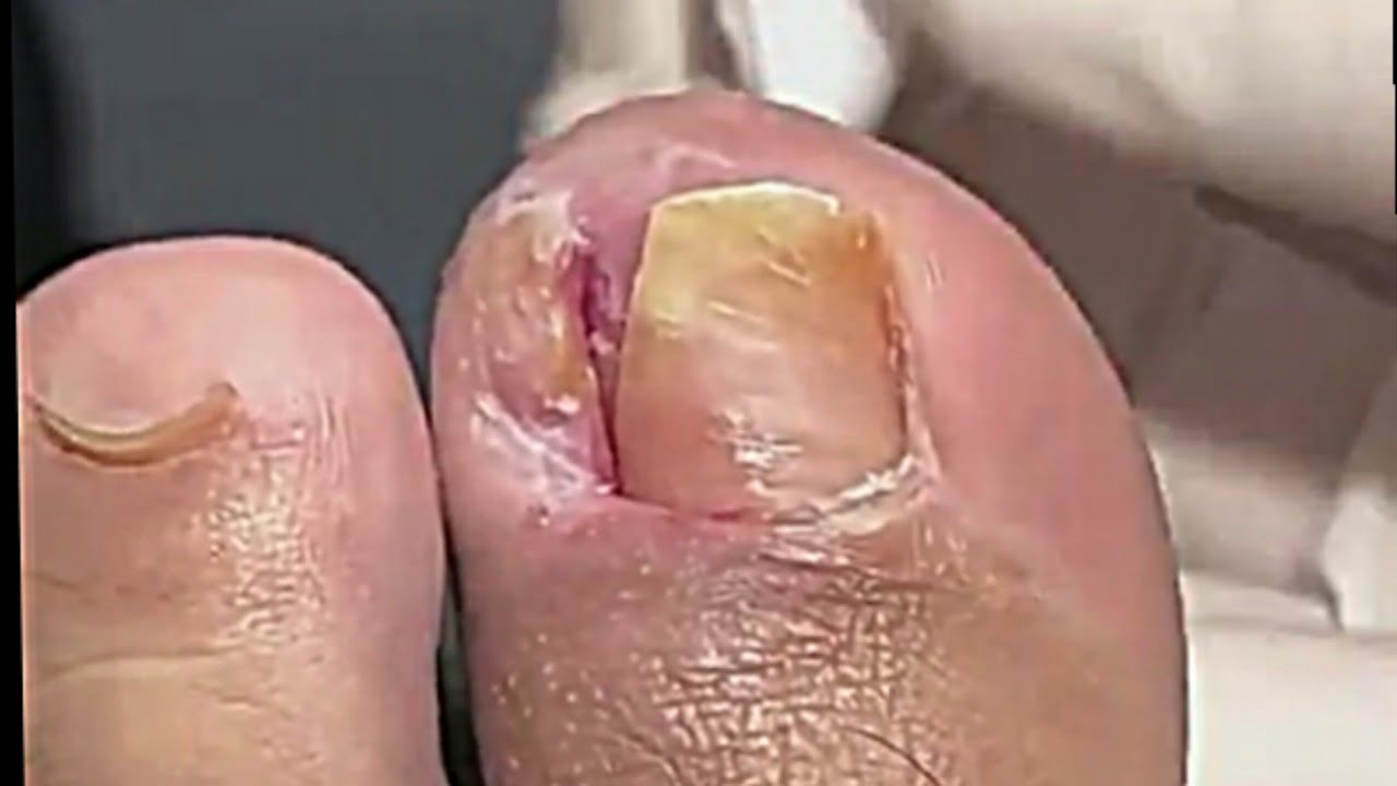 Long Infected ingrown Toenail Removal Treatment by Podiatrist How To get ri...