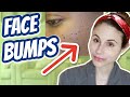 How to get rid of bumps on the face| Dr Dray
