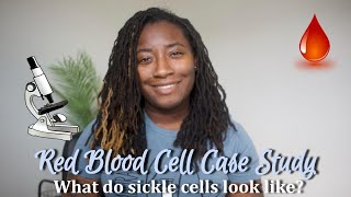 What does sickle cell anemia look like under the microscope? | Hematology Lab Case Study