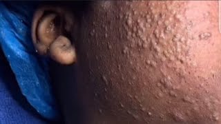 Blackhead Extraction Therapy — Transform Your Skin Today