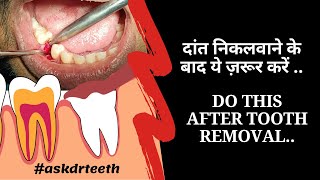 Things to do after Tooth Removal | ENGLISH SUBTITLES