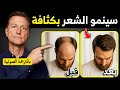 الحل السحري لتساقط الشعر والصلع الوراثي