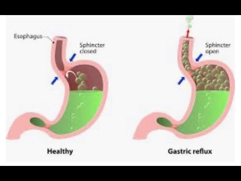 أمراض الجهاز الهضمي أسباب الارتجاع الحمضي في المريء
