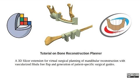 Mandible reconstruction | 3D Slicer Tutorial