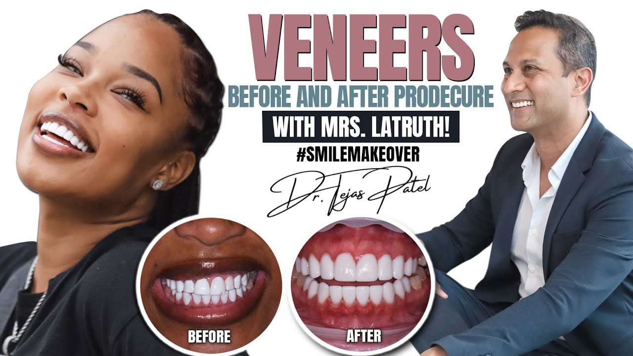 Latruth Wife Veneers Before And After Procedure! #Smilemakeover
