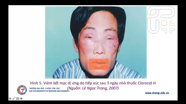 Viêm kết mạc dị ứng bao lâu thì khỏi